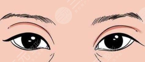八大处马继光做双眼皮怎么样，案例图欣赏~