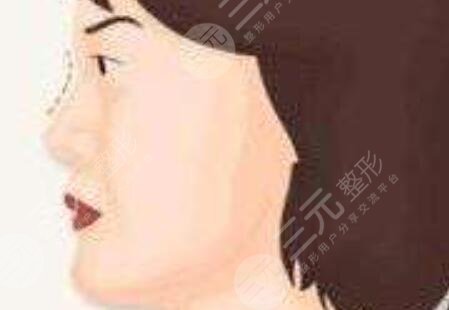 武汉同济邓裴怎么样？分享隆鼻失败修复案例，术后随便晃动揉捏~