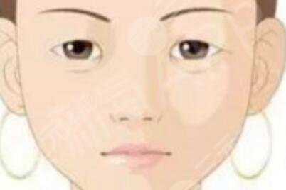 北京延世金奇龙修复双眼皮案例术前