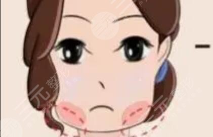 余恩旭脂肪填充怎么样？技术好吗？分享一则真实脂肪填充案例~