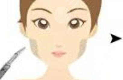 自体脂肪填充额头+硅胶假体隆鼻手术前后果对比图和恢复过程