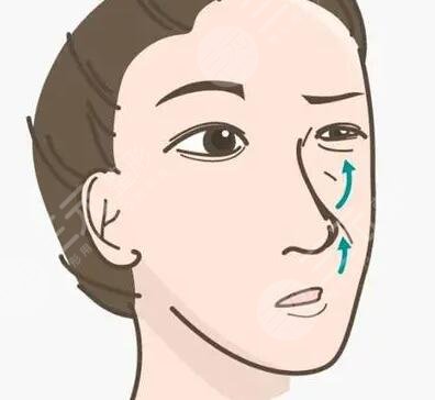 长春朗妍假体隆鼻前后恢复过程对比图