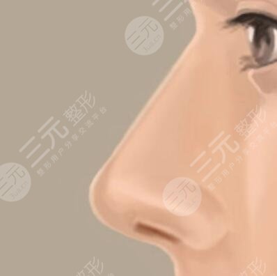 自体脂肪丰鼻唇沟真实记录前后果对比图