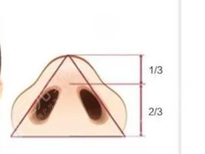 蒜头鼻整形前后对比案例曝光