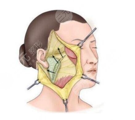 金华,华美,整形,医院,埋线,提拉,10年,青春