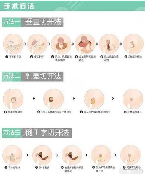 棒棒糖法缩胸是什么
