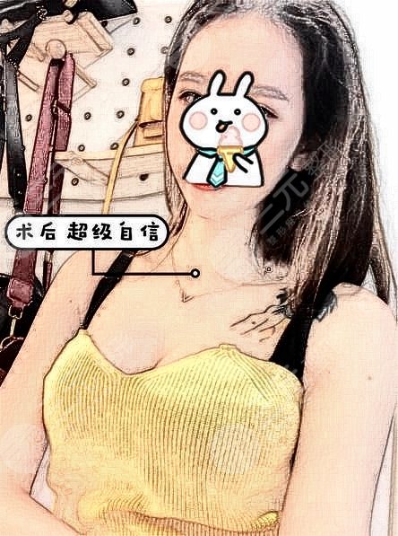 上海市棒棒糖法乳房缩小手术果图