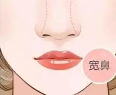 惠州整形医院做的磨骨+隆鼻 美了美了