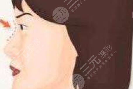 缩鼻翼术后1天