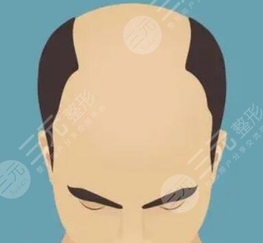 徐州新生毛发医院是正规医院吗？附M型植发经历分享