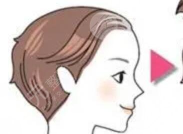 广州培生植发怎么样