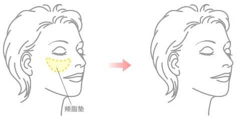 去颊脂垫果怎么样 取颊脂垫手术前后对比照片