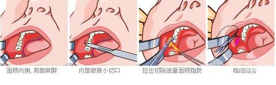 去颊脂垫果怎么样 取颊脂垫手术前后对比照片