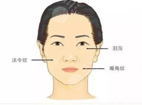 自体脂肪面部填充，年轻才是真的美~~~