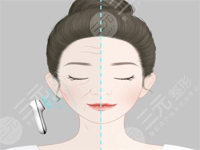 7d聚拉提做眼袋手术之后