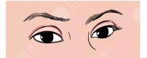 南京鼓楼医院双眼皮手术案例