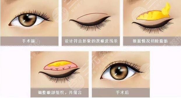 南京鼓楼医院双眼皮手术案例