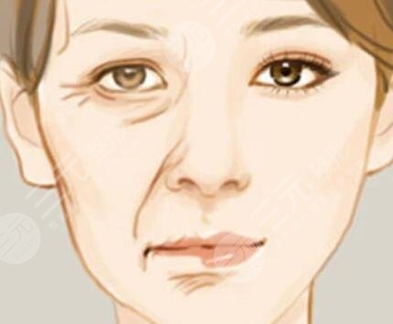 36岁女7d聚拉提做全脸面部紧致除皱案例果