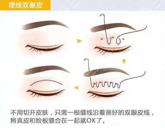 埋线双眼皮一到7天图片分享,附埋线双眼皮恢复图片过程