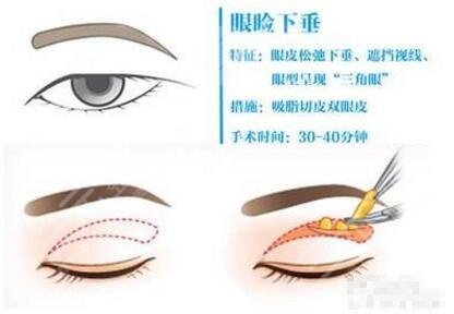 上睑下垂