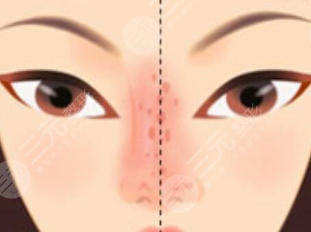 鼻翼缩小手术过程