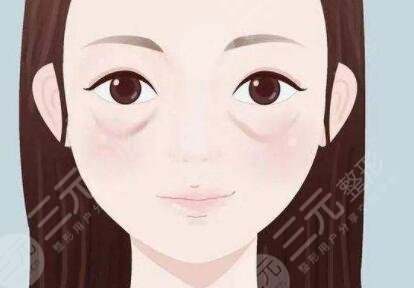 泪沟填充前后对比照片过程图片