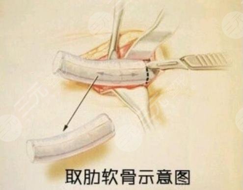 肋软骨隆鼻取肋骨过程详情解析:肋软骨隆鼻亲身果记录并分享~