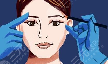 全切双眼皮7mm面诊