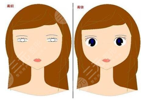 终于有了双眼皮