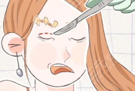 割双眼皮图片前后对比