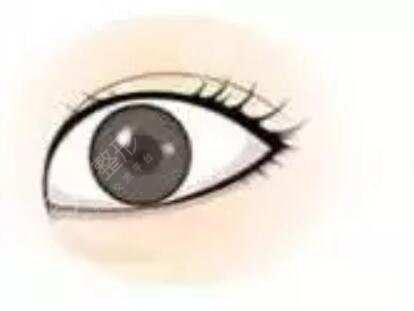 欧式双眼皮术后一个月