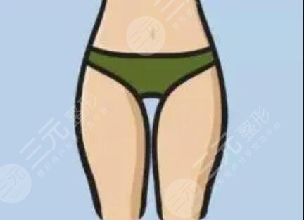 腰腹吸脂后一天