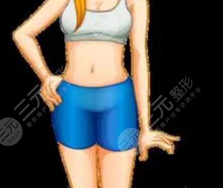 腰腹吸脂第五天