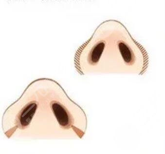 陈桂飞医生隆鼻术前照片