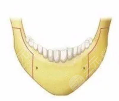 成都华西医院磨骨怎么样