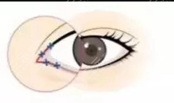 西京医院潘勇修复双眼皮价格+案例图