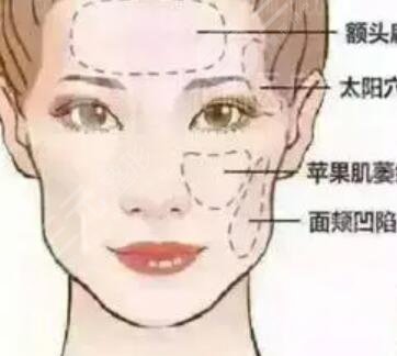 刘中国脂肪填充好吗?脂肪填充案例6月份做的~