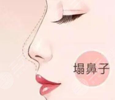 仿生天鹅弧美鼻自然翘挺术后一周
