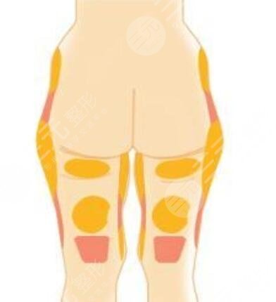 大腿环吸果图真人术后反馈,纤纤玉腿轻松拥有~