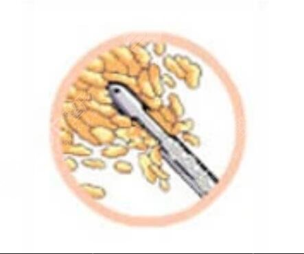 fotona火凤凰溶脂有用吗?优势解析|面部溶脂案例