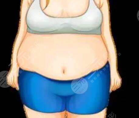 肚子吸脂15天恢复图:水桶腰蜕变为小蛮腰~