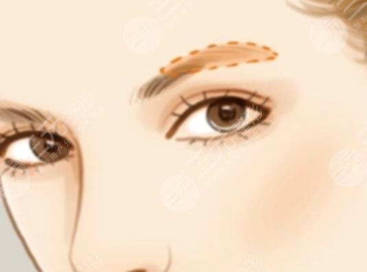 激光洗眉过程详情