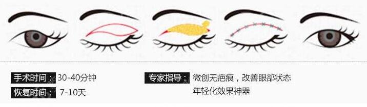 双眼皮手术