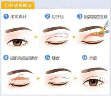 双眼皮术后果
