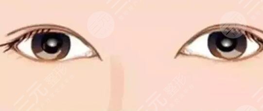 【看过来】南昌大学第一附属医院整形科黄娜双眼皮120天果~