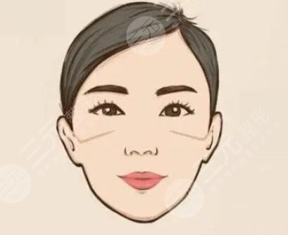 上海九院颧骨内推案例，颧骨内推术后6个月的美照走一波！