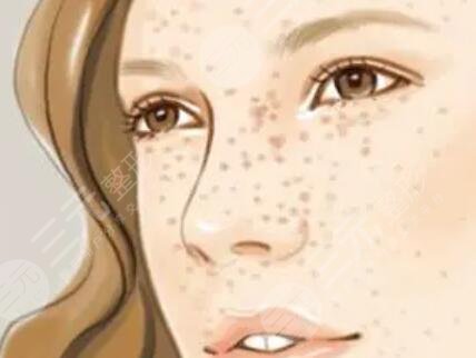 郑州人民医院美容科激光祛斑案例，2月刚恢复好！