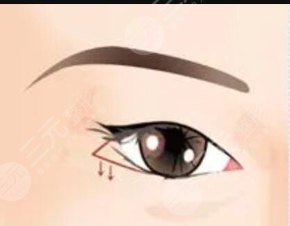 上海华山医院吴包金双眼皮一个月