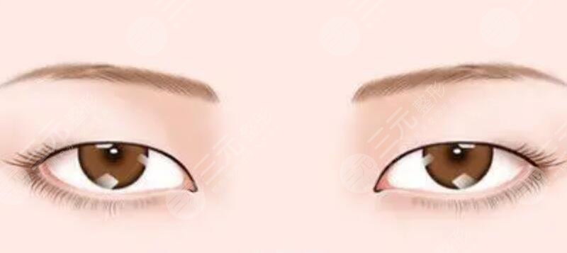 找到适合自己的双眼皮风格