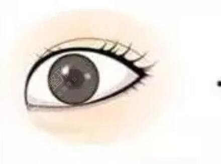 冷向锋发展双眼皮的优势